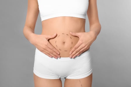 Tummy tuck scar