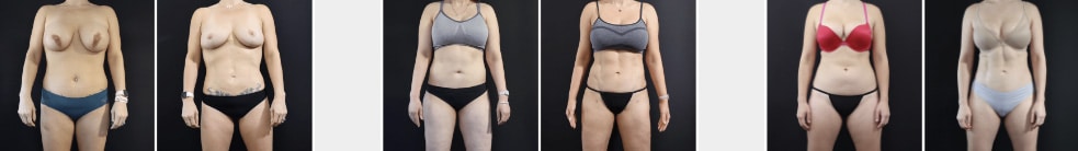 Vaser High Definition Liposuction San Francisco