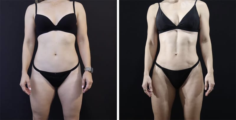 Vaser Lipo before and after