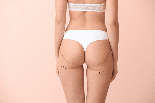 Vaser Liposuction Before And After Photos