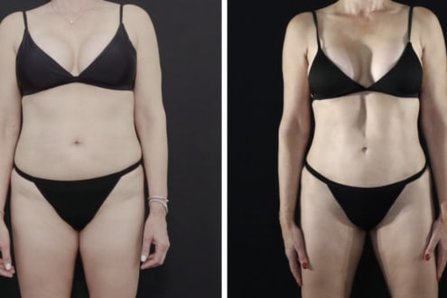 Vaser Liposuction before and after is it worth it