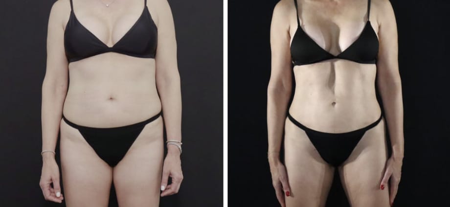 Vaser Liposuction before and after is it worth it
