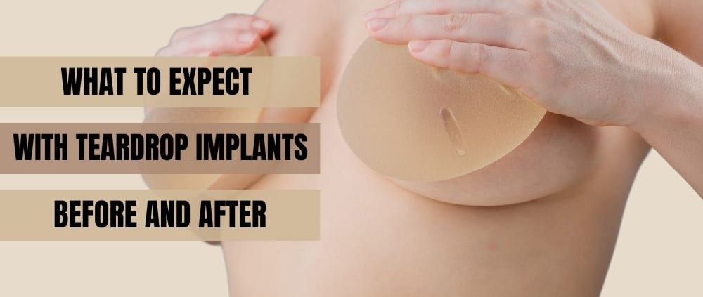 What to Expect With Teardrop Implants Before and After