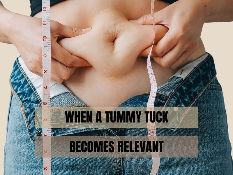 When A Tummy Tuck Becomes Relevant