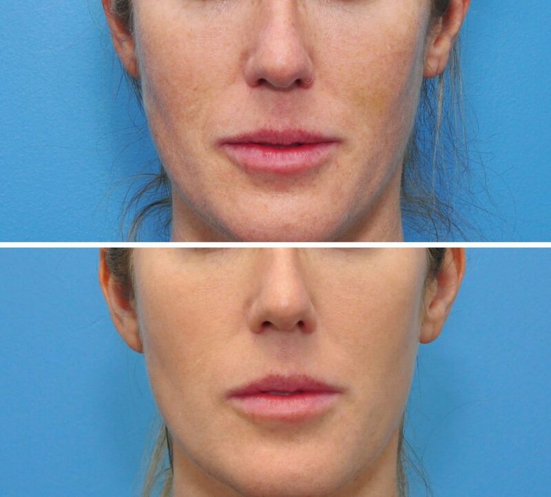 bbl photo facial before and after