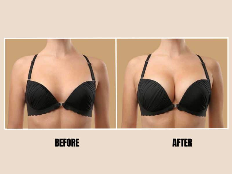  before and after breast lift with implants