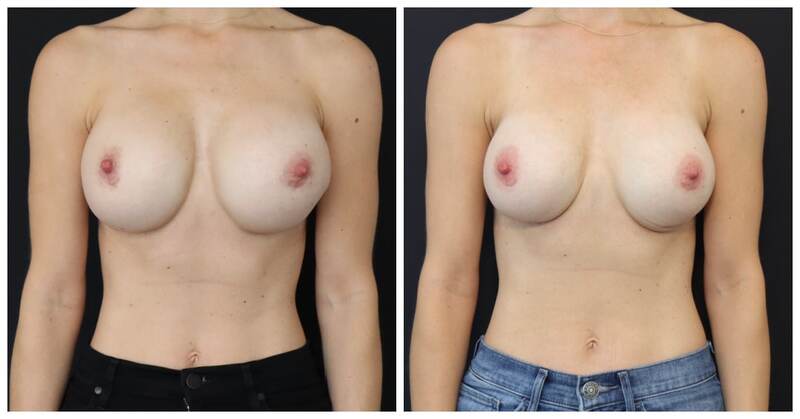 breast implant revision Before and After san Francisco