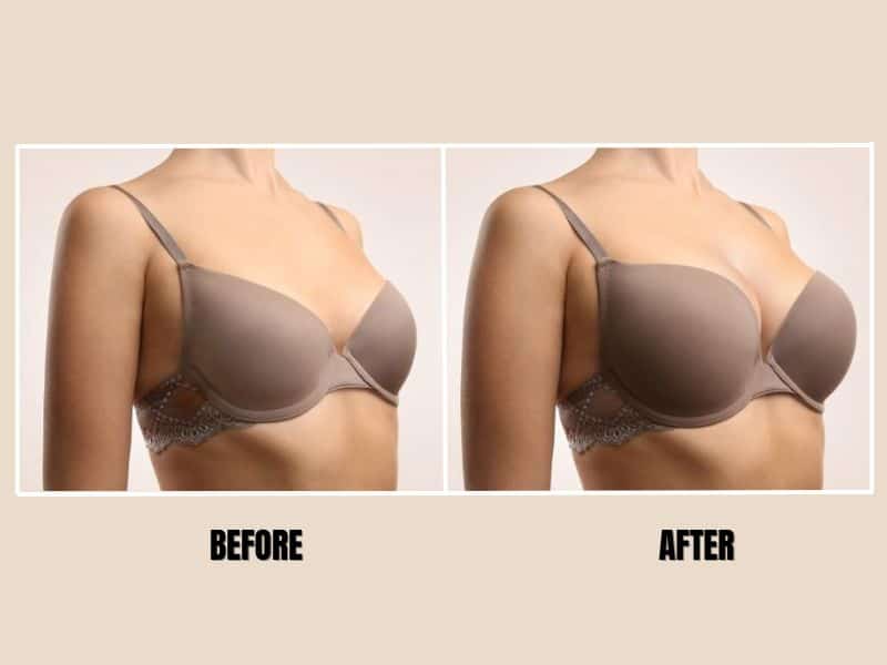 breast lift before and after with implants