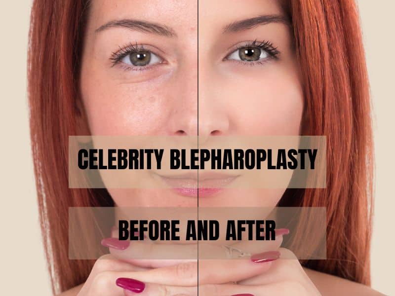 celebrity blepharoplasty before and after