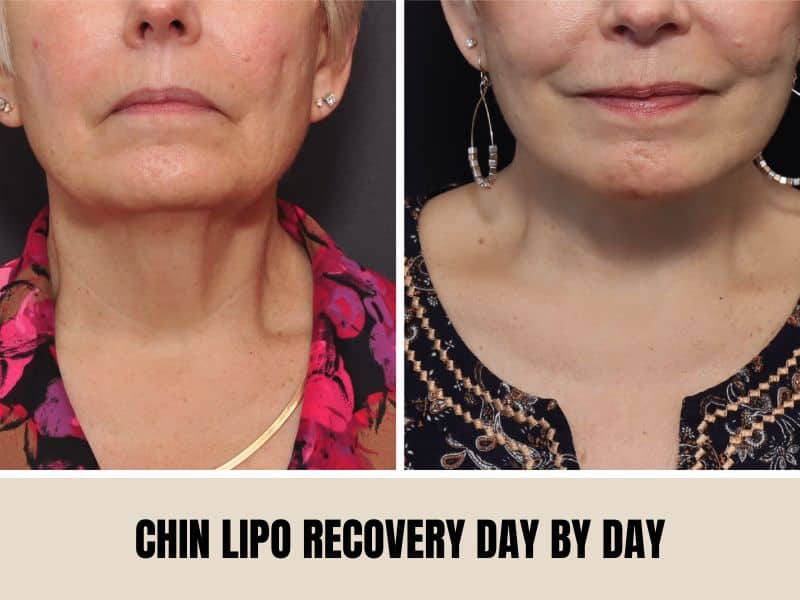 chin lipo recovery day by day