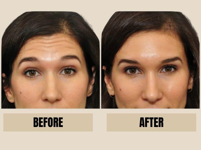dermal fillers before and after