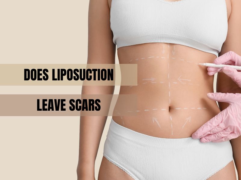 does liposuction leave scars