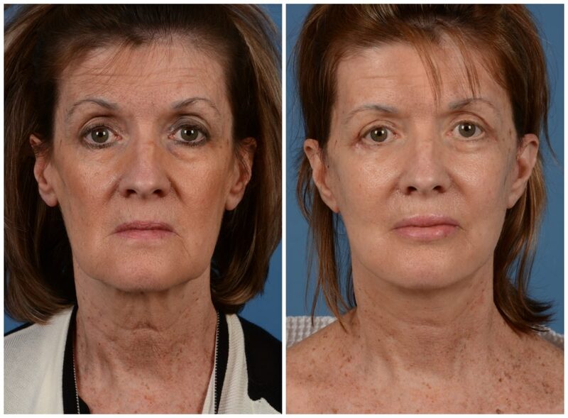 facial fat grafting san francisco