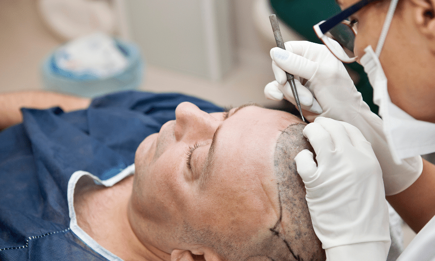 choosing a qualified hair transplant surgeon