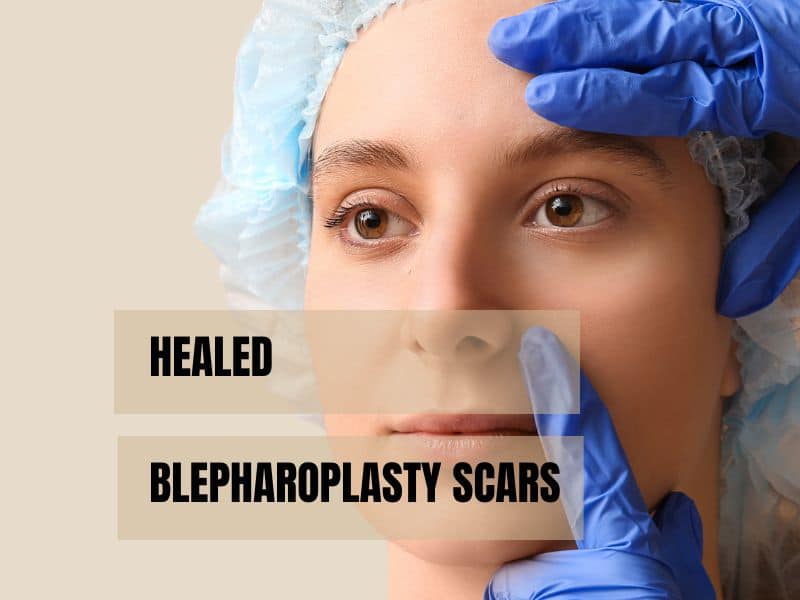 healed blepharoplasty scars