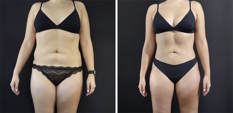 Liposuction in San Francisco Bay Area