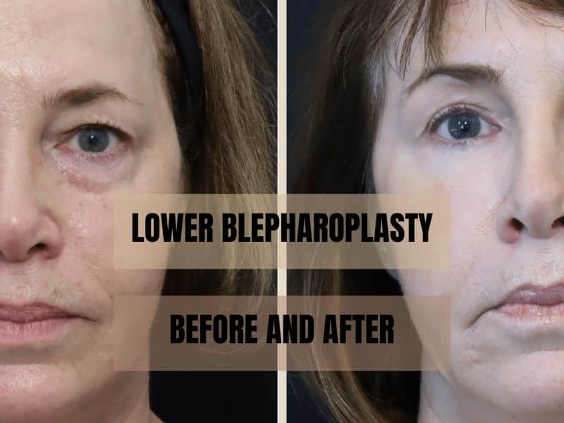 lower blepharoplasty before and after