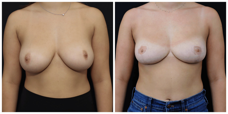 Breast Reduction San Francisco