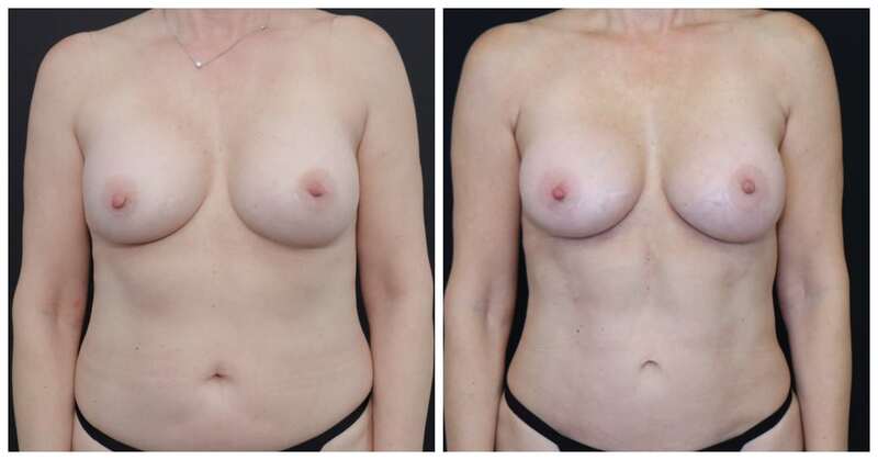 san Francisco breast implant revision Before and After