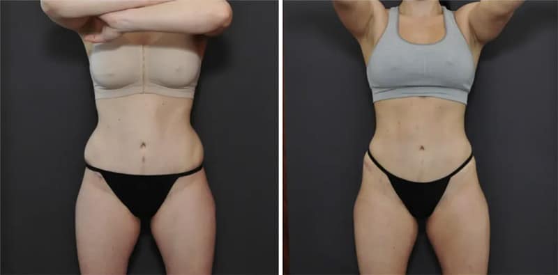 San Francisco Bay Area Liposuction Surgery