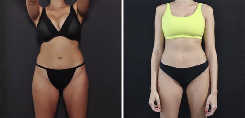 San Francisco Bay Area Liposuction