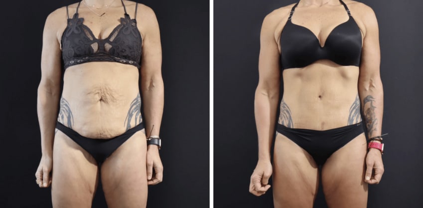 Tummy Tuck Recovery San Francisco Bay Area