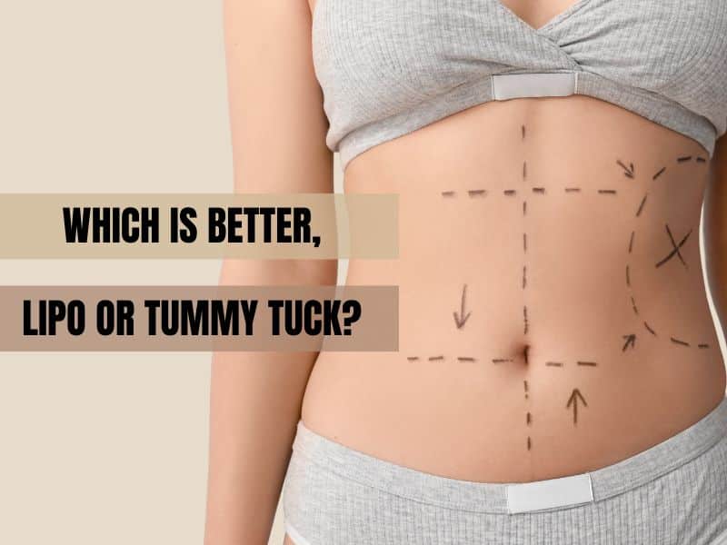 which is better lipo or tummy tuck
